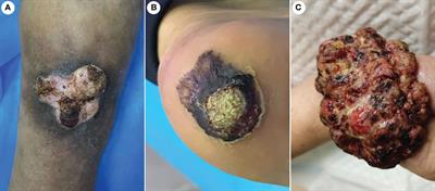 Cutaneous verrucous carcinoma: A clinicopathological study of 21 cases with long-term clinical follow-up